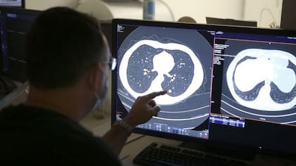 La cirugía tradicional para extirpar tumor de pulmón (como el señalado en esta foto de archivo) es invasiva y deja cicatrices