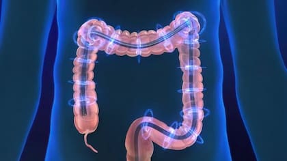 La colitis microscópica solo puede detectarse con una biopsia intestinal