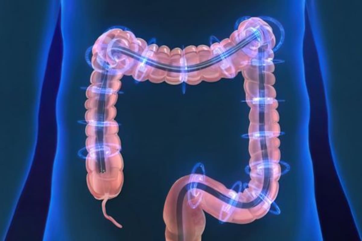 La colitis ulcerosa y la enfermedad de Crohn pueden provocar diarrea persistente, dolor abdominal y sangrado, síntomas que suelen confundirse con otros trastornos digestivos