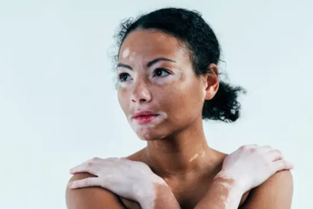 La condición es más notable en personas de piel oscura, pero afecta igualmente a todos los grupos étnicos