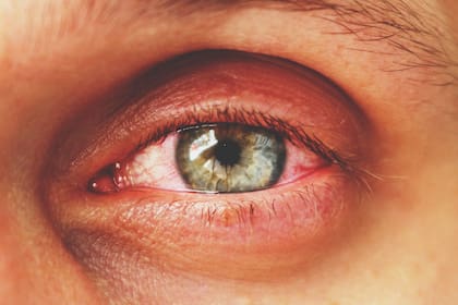 Los ojos rojos pueden acompañarse de irritación, dolor, sequedad, secreción, sensibilidad a la luz y visión borrosa