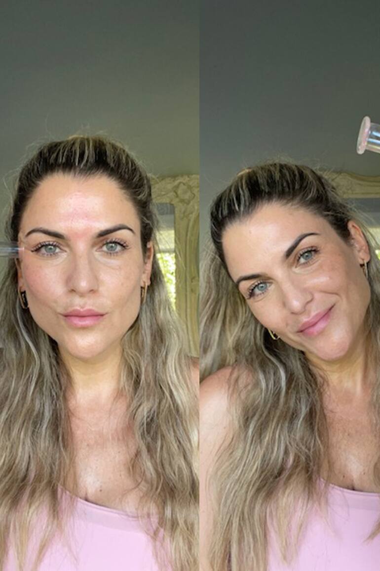 La cosmiatra Lorena Erlijman enseña en sus redes el cupping, una de las técnicas de moda