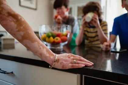 La despigmentación ocurre generalmente en las zonas de la piel que están expuestas al sol, como las manos