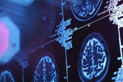 La detección temprana de la enfermedad es clave para mantener una mejor calidad de vida