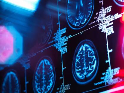 La doctora explica que, en función de qué tipo de demencia se sufra, así se verán afectadas unas partes u otras del cerebro.