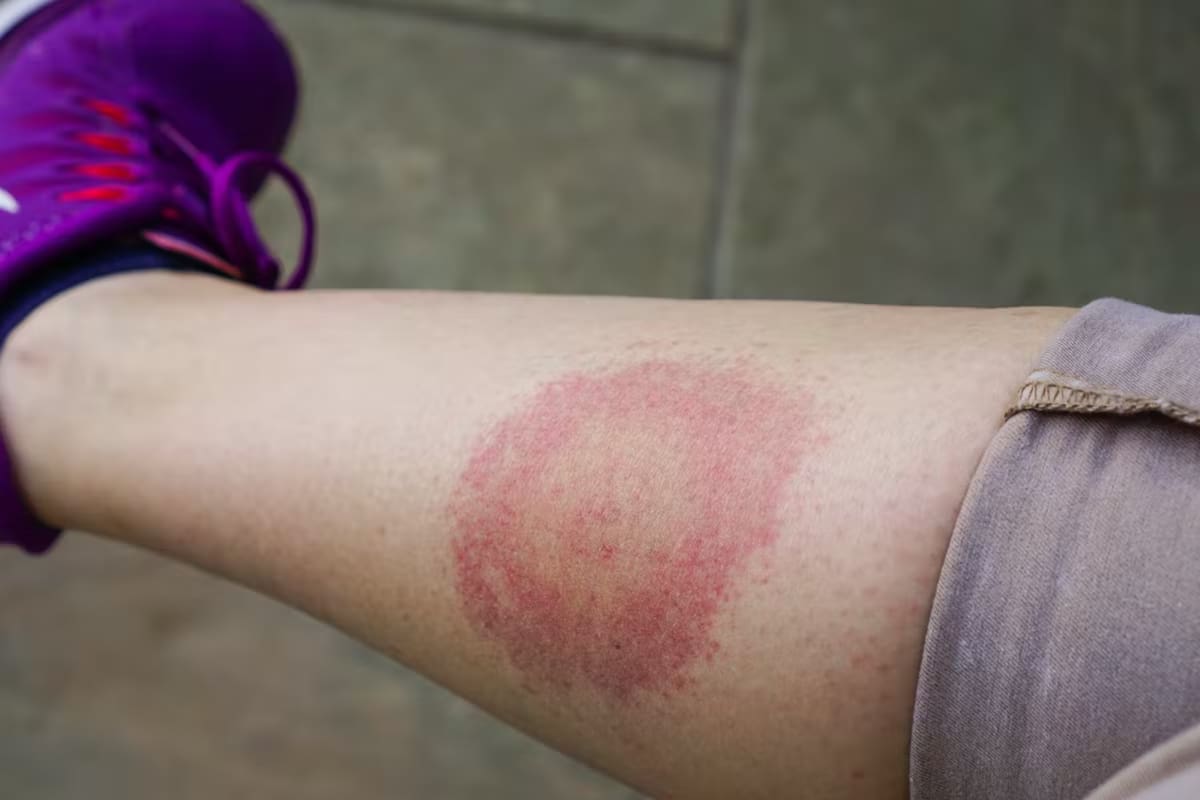 La enfermedad de Lyme es transmitida por la picadura de garrapatas infectadas