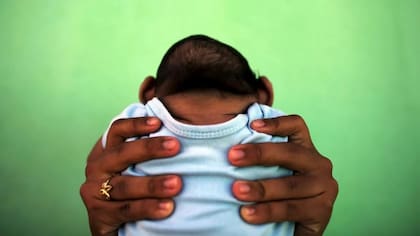 La enfermedad del Zika es causada por un virus transmitido principalmente por mosquitos del género Aedes. La infección durante el embarazo puede causar microcefalia en los bebés y otras malformaciones congénitas