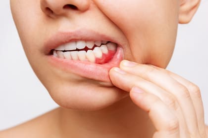 La enfermedad periodontal avanzada puede ser incurable; sin embargo, los dentistas y los periodoncistas pueden recomendar tratamientos que retarden o prevengan una mayor pérdida de encías y hueso.