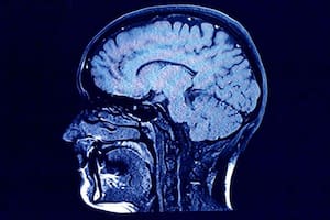 La Esclerosis Lateral Amiotrófica aún está rodeada de interrogantes vinculados a su origen y tratamiento