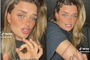 La española Tatiana Kisiel mostró a través de TikTok las marcas que posee por el tratamiento del láser