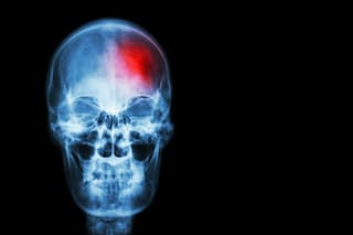 Las terapias psiquiátricas que podrían ayudar a la curación del cerebro después de un ACV