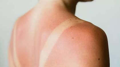 La exposición prolongada al sol puede afectar seriamente la salud de la piel, los ojos y el sistema inmunológico