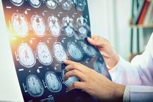 La FDA incluyó su advertencia de seguridad más severa para un fármaco aprobado, un "aviso en un recuadro" en su envase en la que se señala el riesgo de inflamación cerebral potencialmente peligrosa de fármacos contra el alzhéimer como Leqembi.