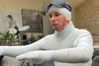 La foto de Instagram de Olivier Rousteing muestra las lesiones que sufrió el año pasado, dijo el diseñador.