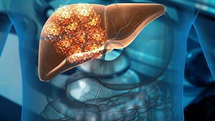 La hepatitis fulminante fue la primera causa de trasplante hepático en el país