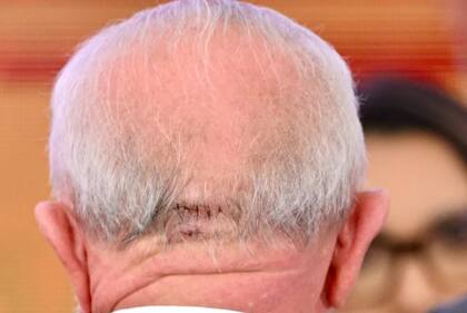 La herida de Lula Da Silva tras caerse en el baño de su casa