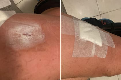 La herida que sufrió al víctima en la pierna izquierda