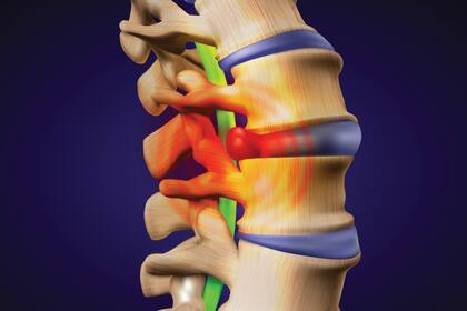 La hernia de disco se produce cuando una parte de un disco intervertebral se sale de su lugar y comprime a las raíces de los nervios cercanos, causando dolor y/o debilidad muscular