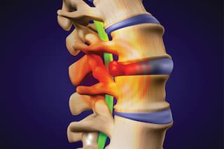 Cómo prevenir ese dolor insoportable en la columna