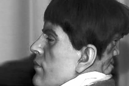 La historia de este hombre que nació con una doble cara detrás de su cabeza es siniestra.