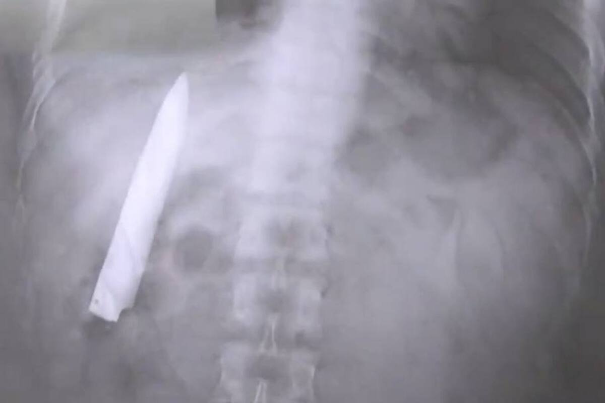 La hoja del cuchillo estaba alojada en el pecho del filipino Kent Ryan Tomao, de 25 años, y se encontraba allí desde un ataque sufrido por el joven 14 meses atrás