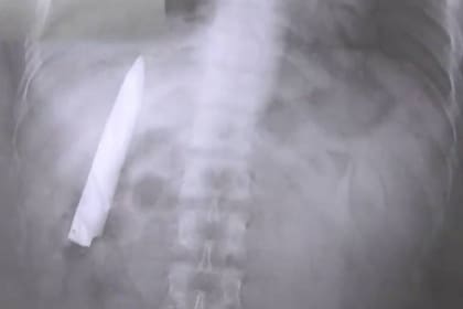 La hoja del cuchillo estaba alojada en el pecho del filipino Kent Ryan Tomao, de 25 años, y se encontraba allí desde un ataque sufrido por el joven 14 meses atrás