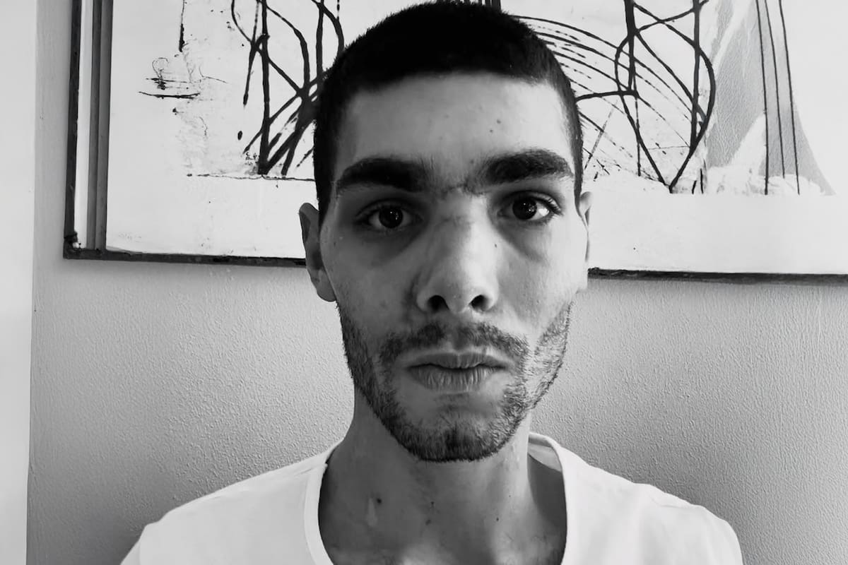 La imagen de Filippo Baroncini, después de la reconstrucción de su rostro