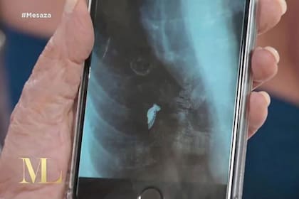 La imagen del ala del ángel en la foto de la radiografía de la muñeca de Salgueiro