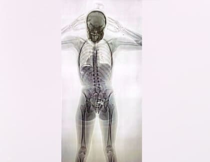 La imagen del escáner del cuerpo de la "mula" con 78 cápsulas de cocaína