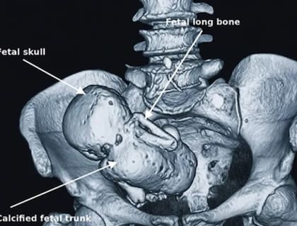 La imagen del Inusual caso de "bebé de piedra" (Foto: International Medical Case Reports Journal)