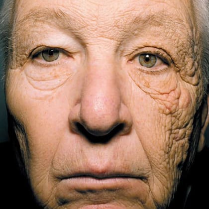 La imagen muestra el deterioro dermatológico que tuvo una mujer que trabajaba como camionera y no se puso protector en la parte de la cara que quedaba expuesta a la ventanilla