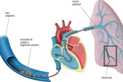 La imagen muestra una trombosis en el circuito venoso. Desde allí migra el pulmón al circuito arterial pulmonar y altera la oxigenación. La tos y el dolor pleurítico es por irritación pleural originado por el derrame pleural.