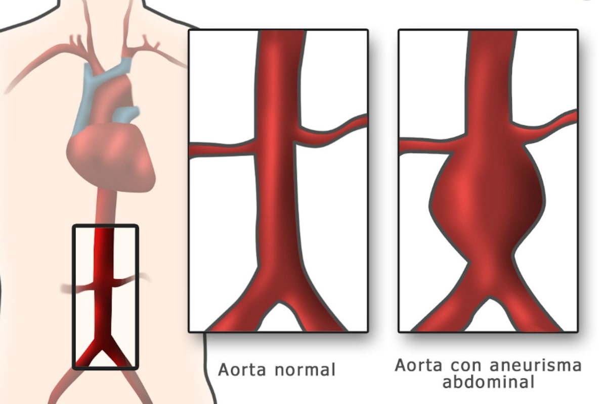 Qué es el aneurisma aórtico, un cuadro médico más común de lo que ...