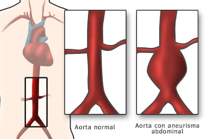 La incidencia de esta afección se incrementó en las últimas dos décadas, debido en parte al envejecimiento de la población