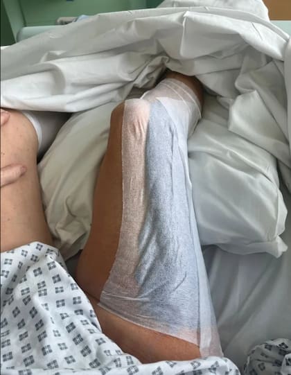 La infección llegó desde su tobillo hasta la ingle (Foto: The Sun)