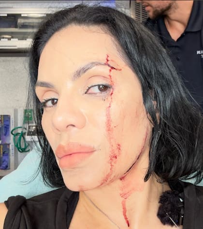 La influencer Nina Santiago comparte fotos de sus heridas tras el accidente (Instagram/@ninaunrated)