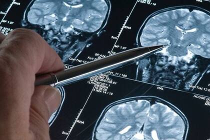 La investigación sobre la enfermedad de Alzheimer está mejorando las perspectivas de los pacientes con demencia en todo el mundo