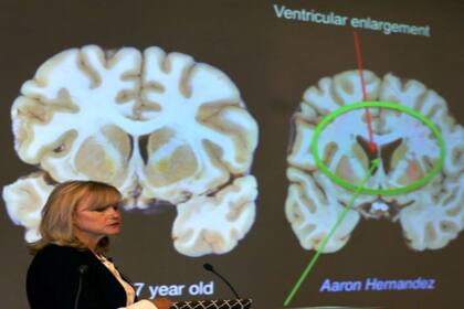 La investigadora Ann McKee presentó los alarmantes resultados del estudio del cerebro de Aaron Hernandez.