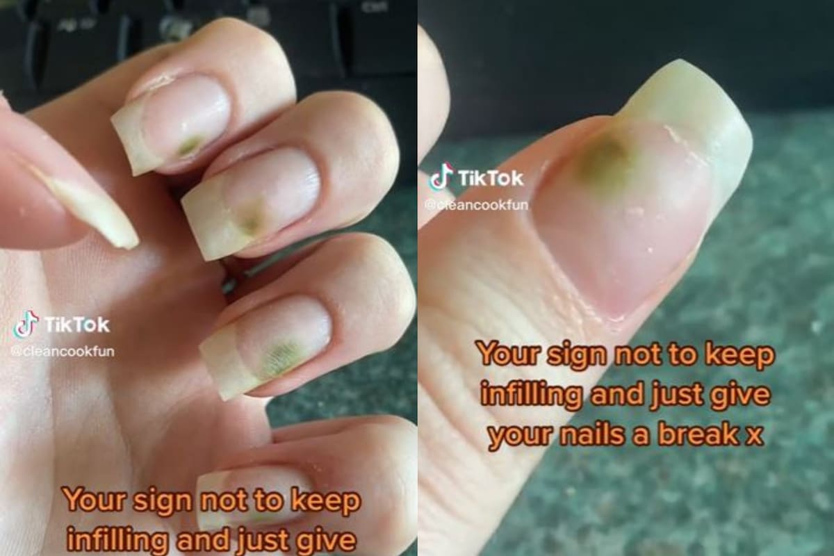 La joven mostró la infección que tuvo después de su tratamiento de belleza