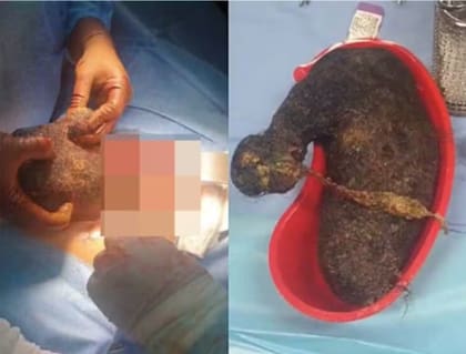 La joven presentaba antecedentes de pica, un trastorno que impulsa a ingerir sustancias no comestibles