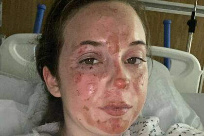 La joven sufrido quemaduras de segundo y tercer grado, pero logró recuperarse (Foto: iStock)