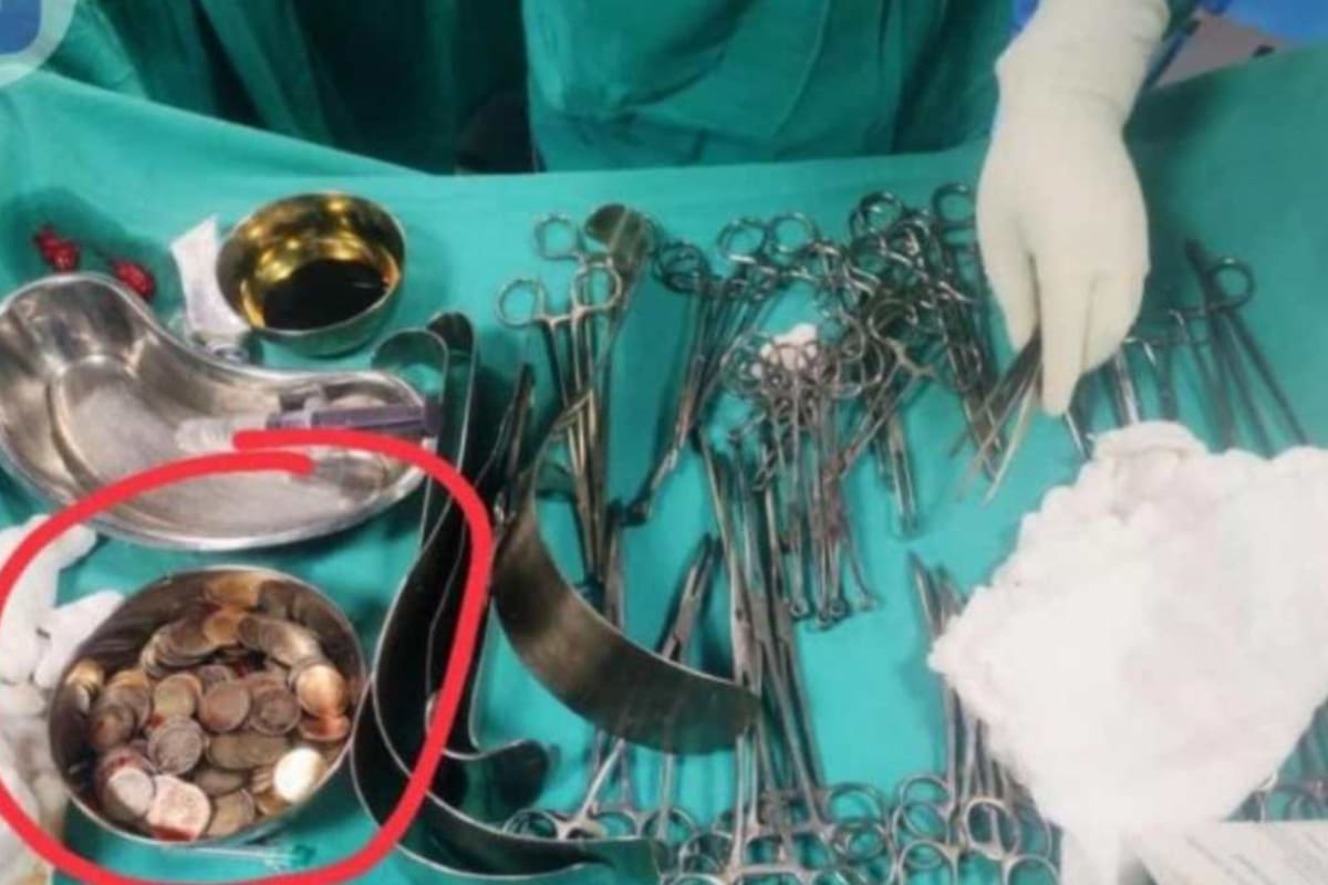 La laparotomía fue el método elegido por los doctores para extraer las piezas (Foto: The Indian Express)