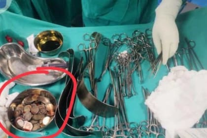 La laparotomía fue el método elegido por los doctores para extraer las piezas (Foto: The Indian Express)