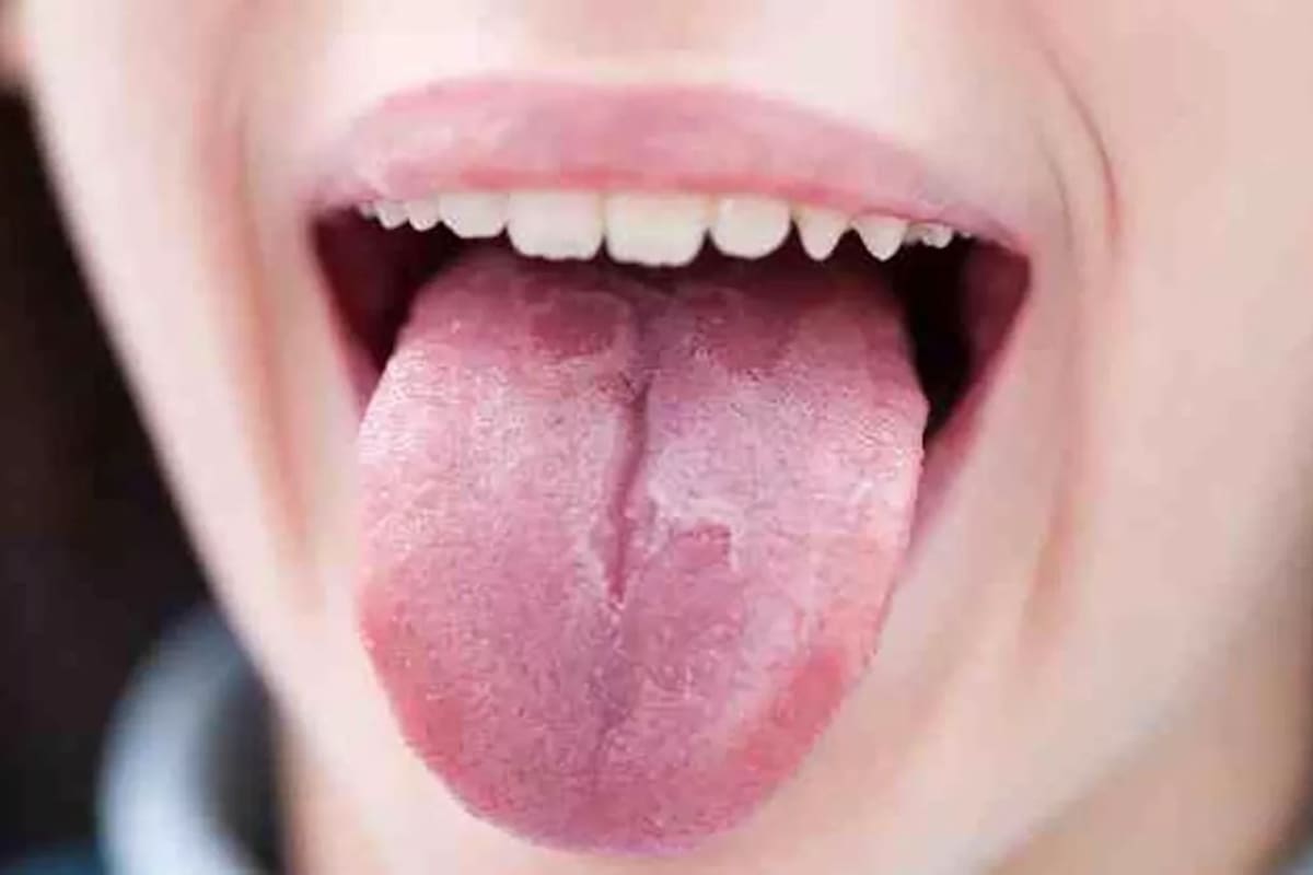 La lengua blanca puede denotar problemas de higiene bucal