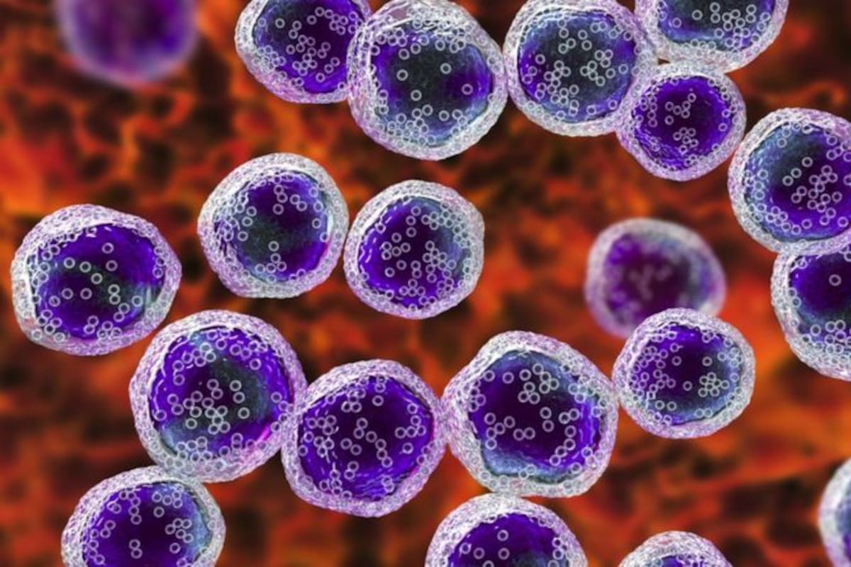 La leucemia suele caracterizarse por un aumento brusco de los glóbulos blancos
