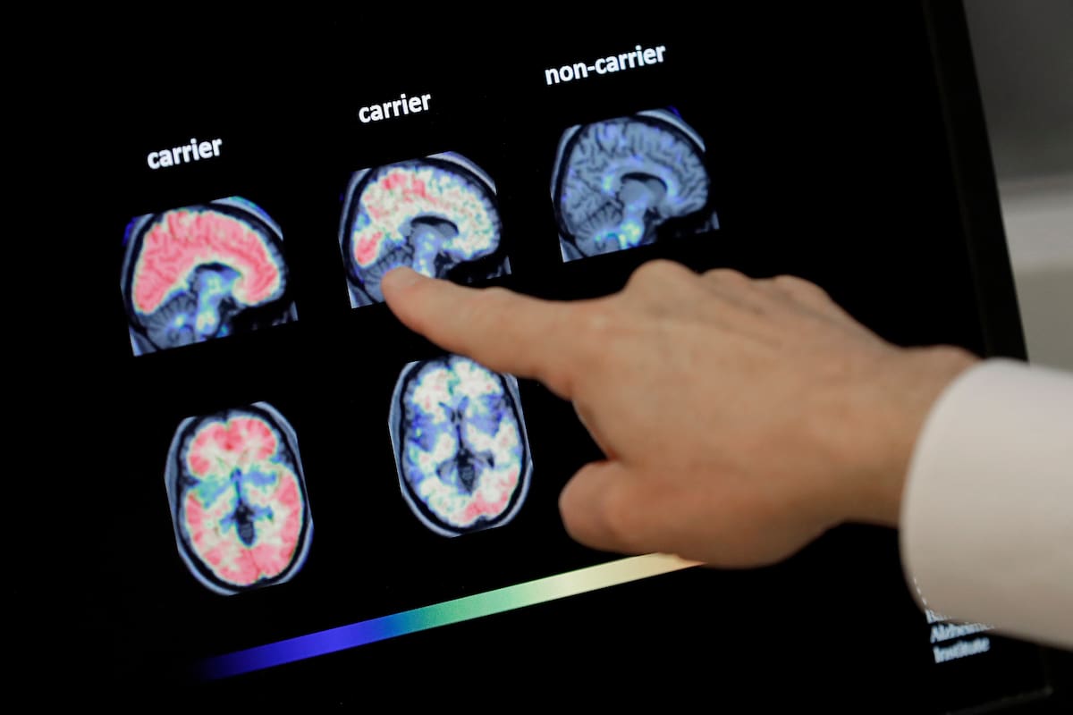 La lucha contra el Alzheimer entró en una nueva era