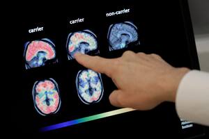 La lucha contra el Alzheimer entró en una nueva era