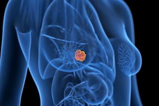 Cáncer de mama: cuándo hay que hacerse la mamografía, si tenés antecedentes familiares