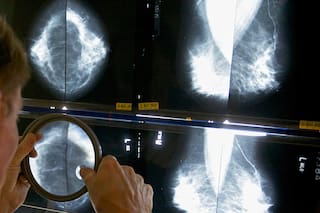 Cáncer de mama: cuándo hay que hacerse la mamografía, si tenés antecedentes familiares
