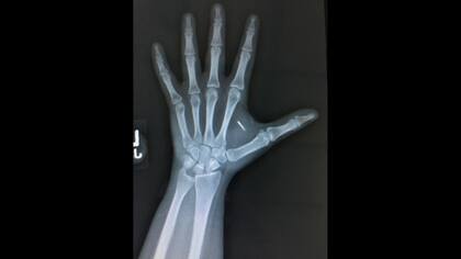 La mano de Janine Medina y el lugar donde se suelen implantar los chips subcutáneos
